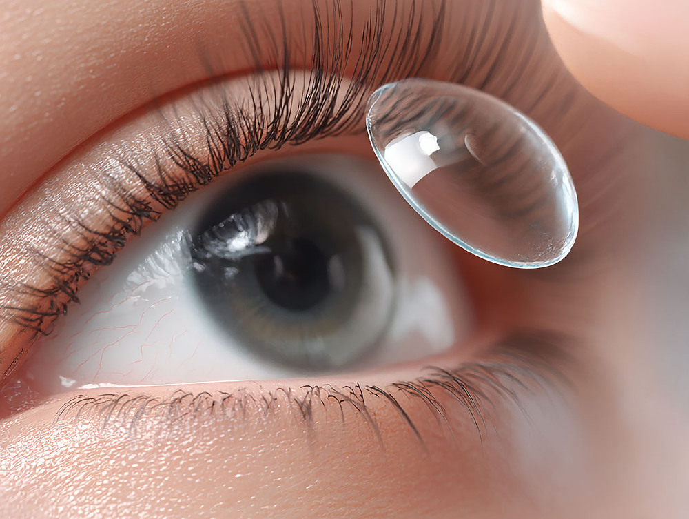 렌즈삽입 교정술