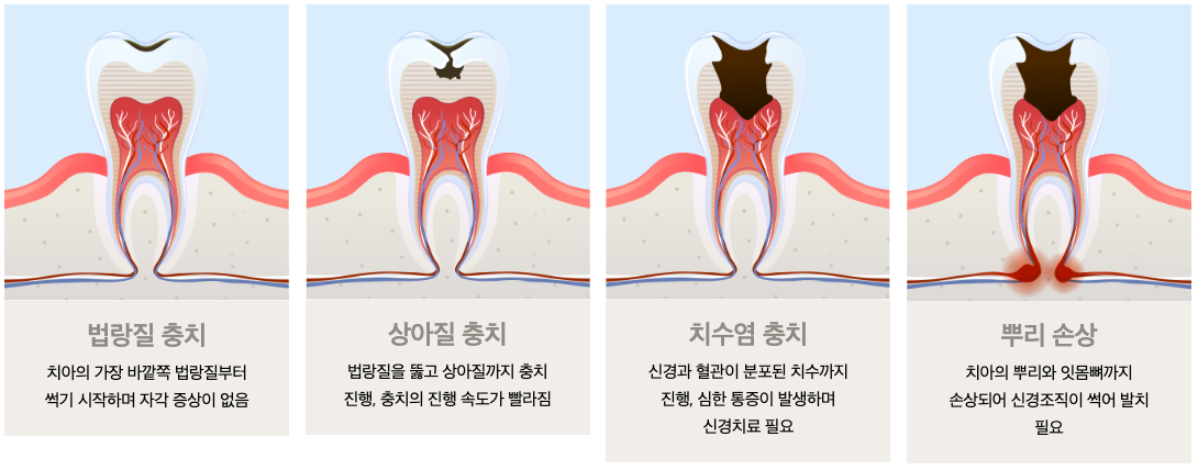 충치치료